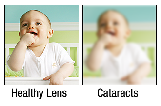 Cataract Vision