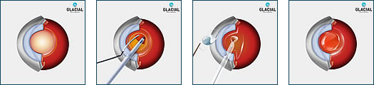 Cataract Surgery