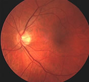 Diabetic retinopathy