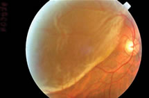 Retinal detachment